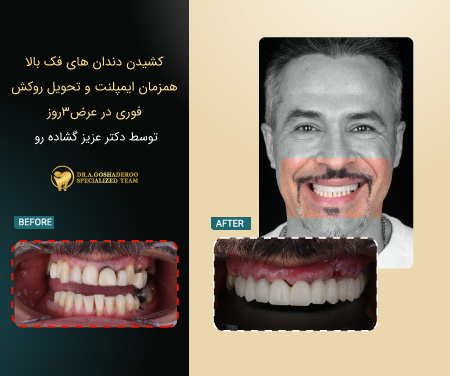 بررسی و طراحی ایمپلنت&zwnj;ها برای درمان All-on-X